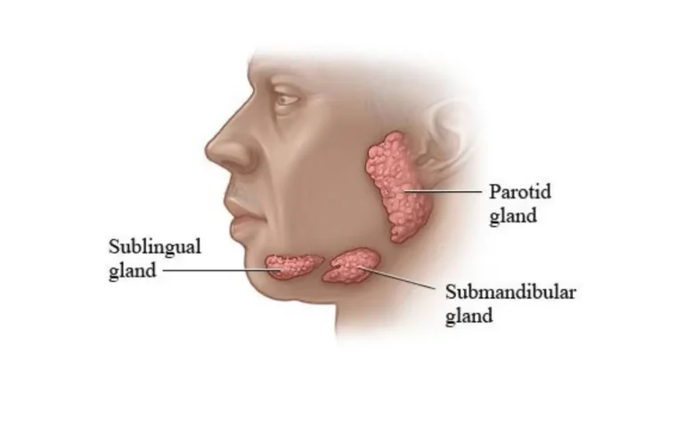 tükürük bezi tümörleri