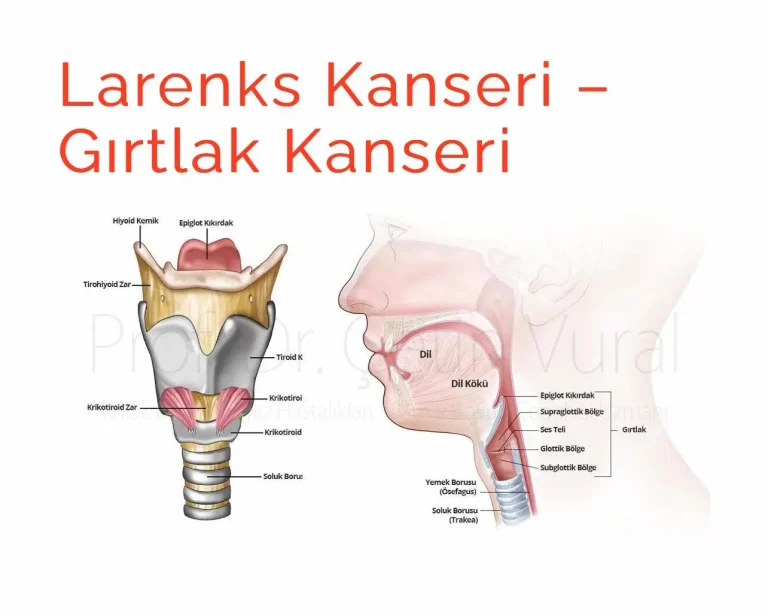 larenks kanseri - gırtlak kanseri cerrahisi
